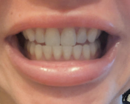 Stylo Blanchissant Violet – Sourire Éclatant Instantané