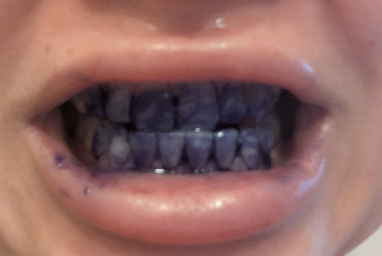 Stylo Blanchissant Violet – Sourire Éclatant Instantané